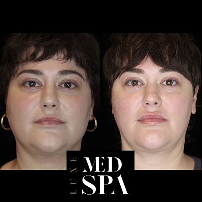 Before and after beauty treatment, Luxe Med Spa.